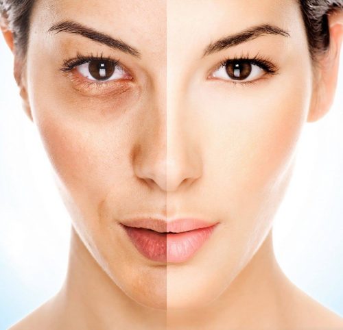 melasma
